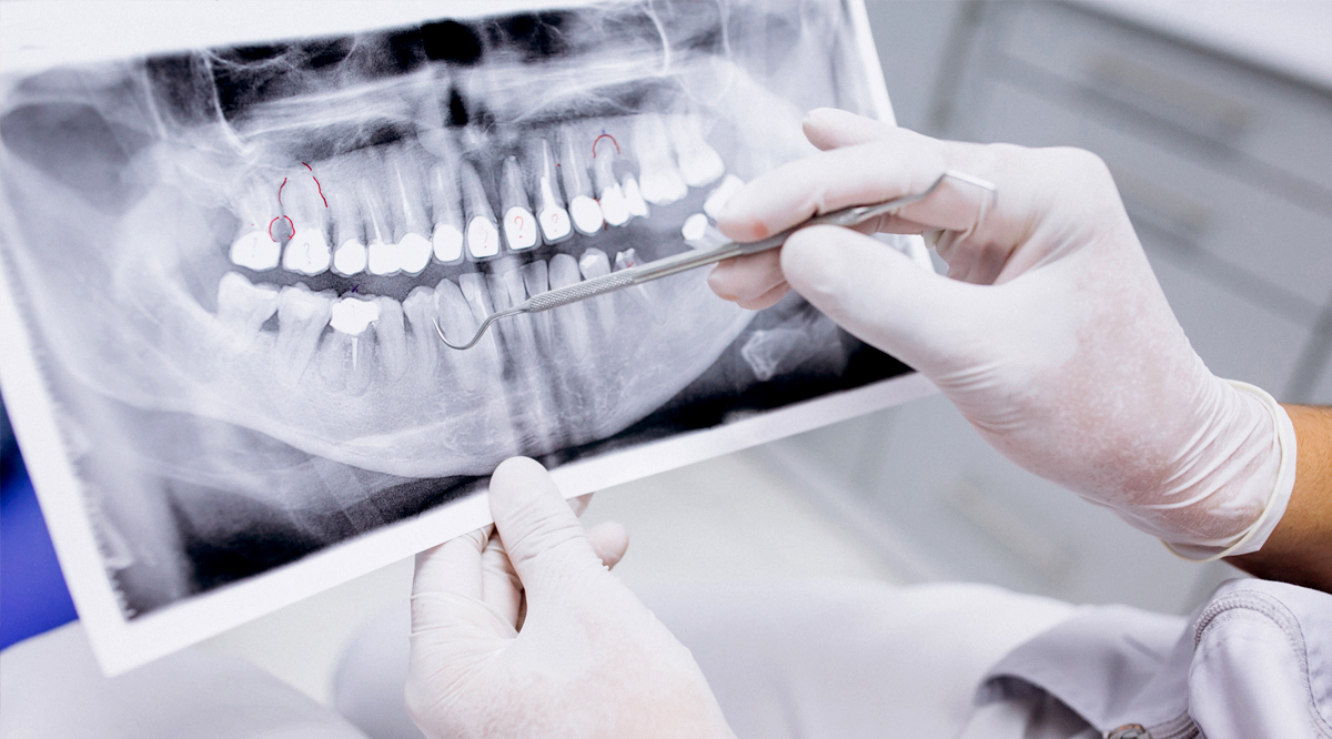 Osteoporosi: il nemico silenzioso dei nostri denti